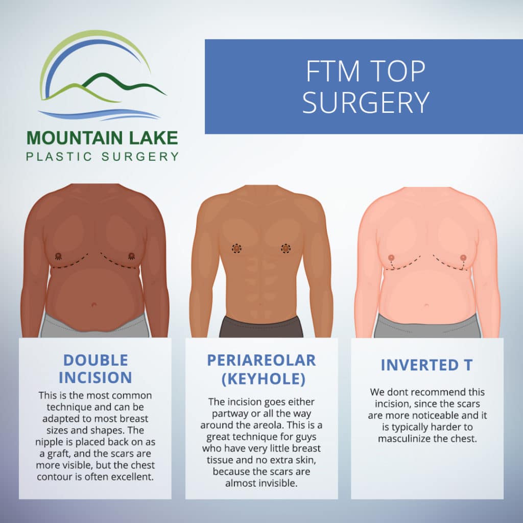 Female to Male Top Surgery | Burlington VT Mountain Plastic Surgery